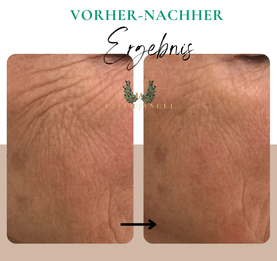 Vorher-Nachher Ergebnisse der Laser-Haarentfernung bei Laser Angel Hamburg