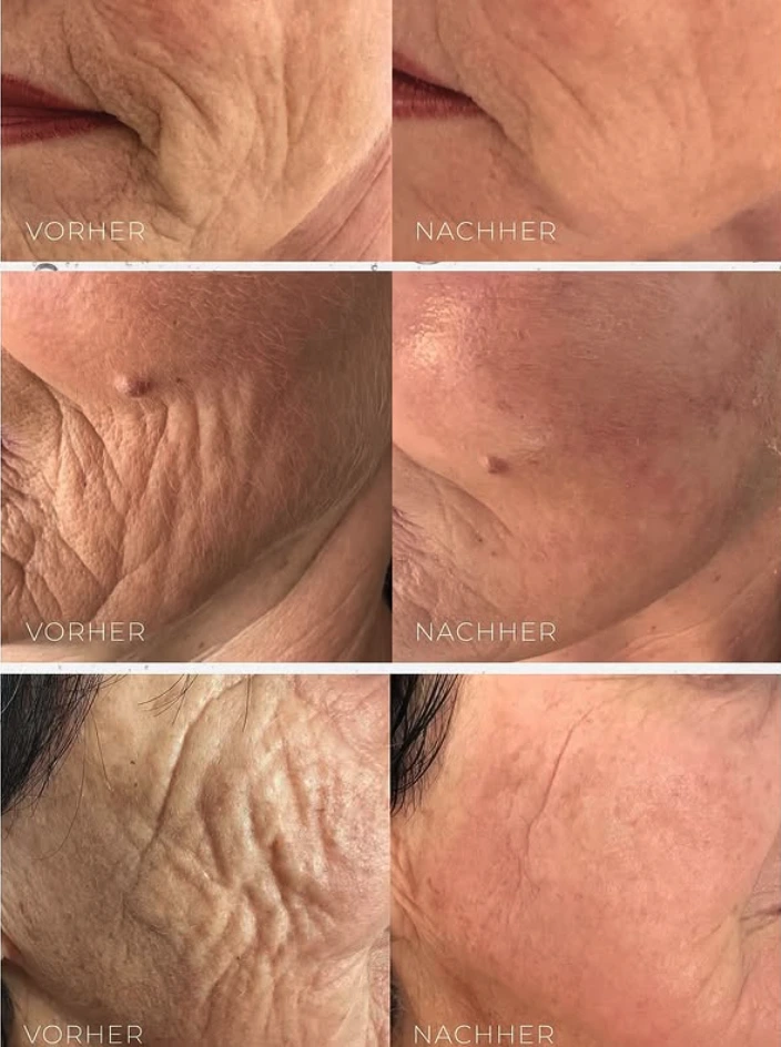 Vorher-Nachher Ergebnisse der Laser-Haarentfernung bei Laser Angel Hamburg